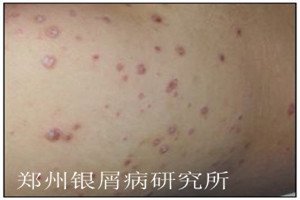 寻常型牛皮癣
