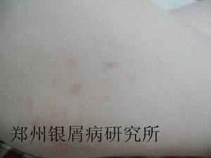 寻常型牛皮癣