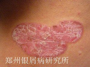 牛皮癣的危害