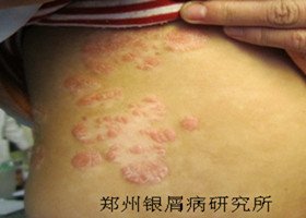 牛皮癣症状