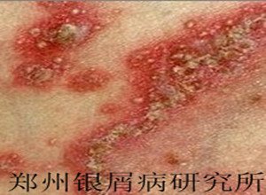 牛皮癣病因