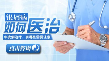 郑州牛皮癣医院！